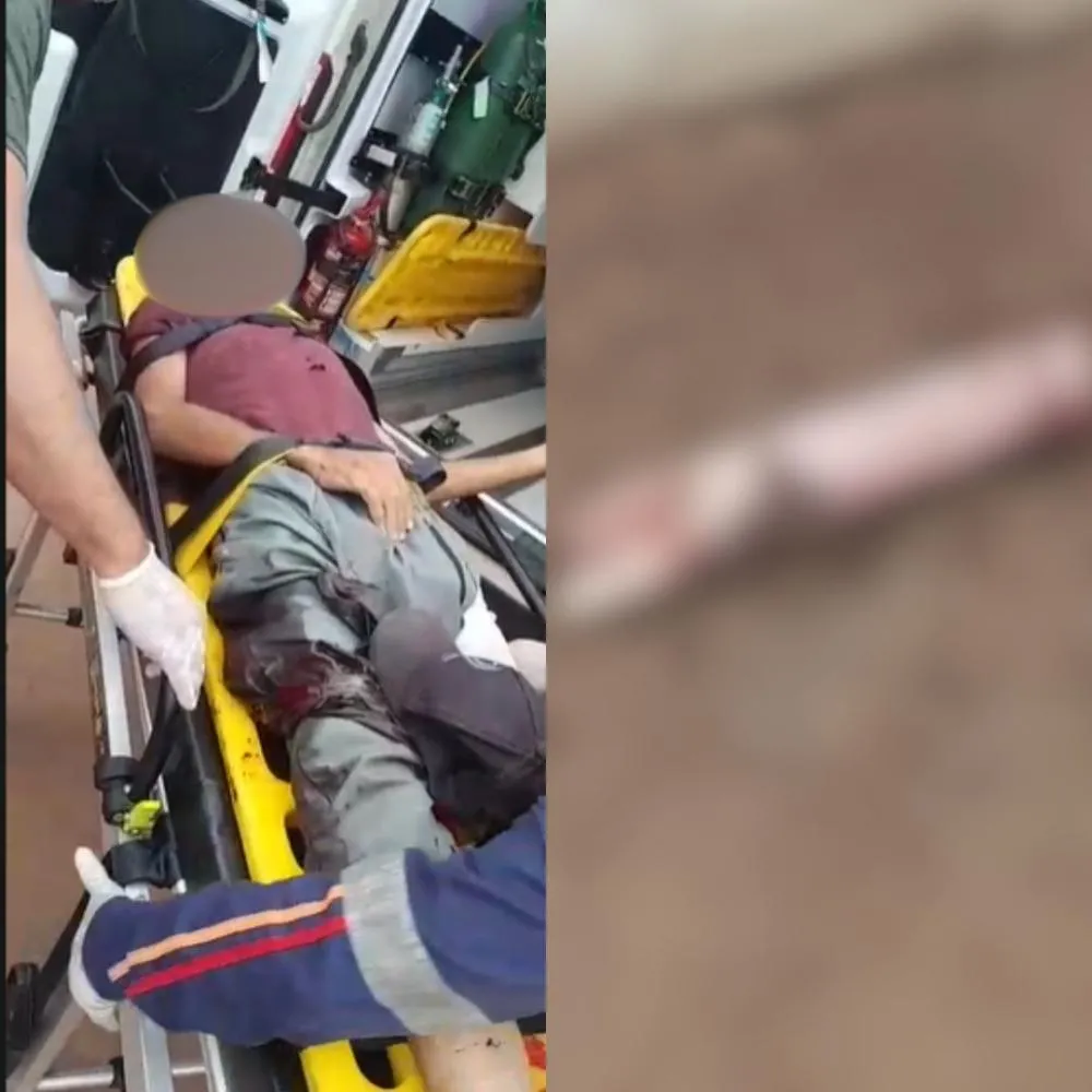 Homem tem perna dilacerada após colisão entre motocicletas nas proximidades da rotatória de Plácido de Castro; 3 pessoas ficaram feridas
