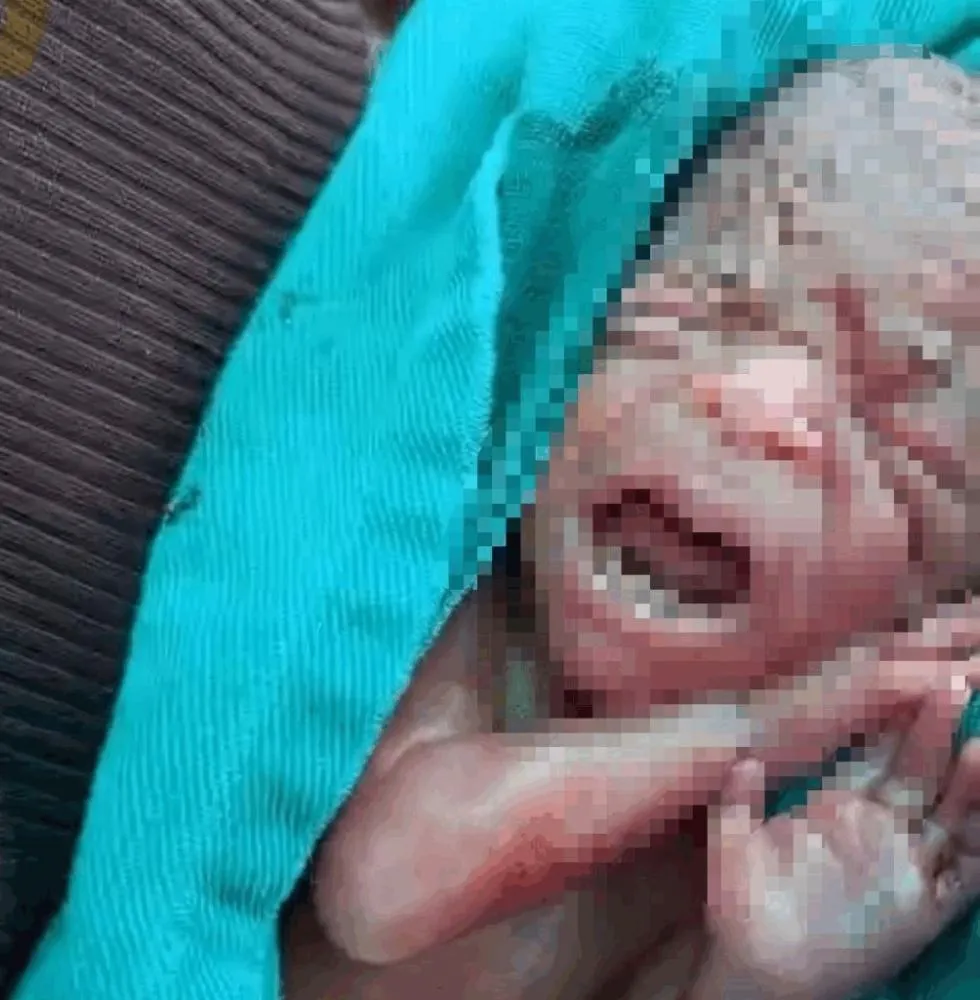 Bebê que “ressuscitou” após ser declarado morto não resiste e falece na UTI de hospital do Ac