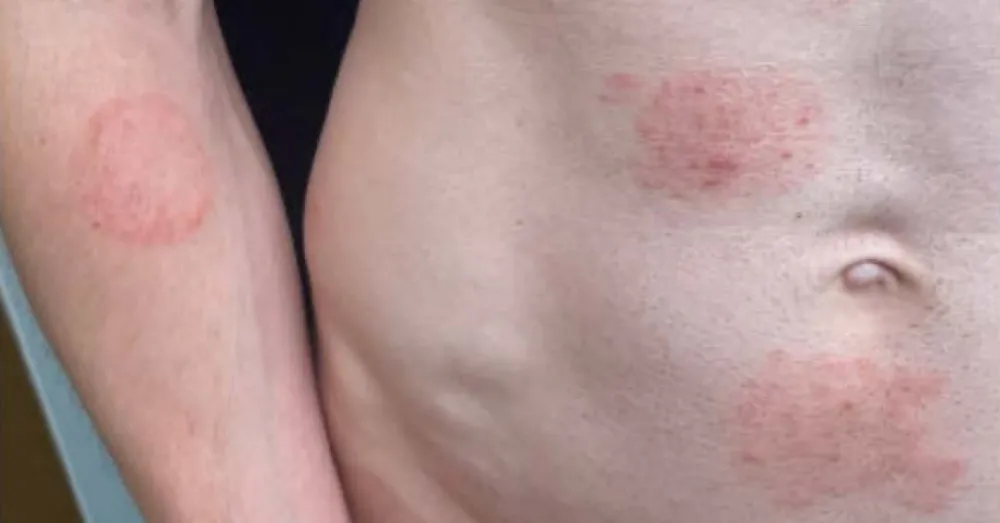 Fungo ‘altamente contagioso’ transmitido por via sexual gera alerta em diversos países