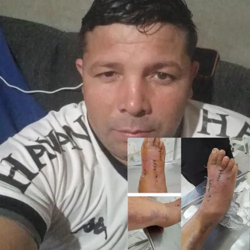 Após queda de moto em ramal e sofrer fratura de ossos do pé direito, morador de Plácido de Castro pede ajuda para custear tratamento e manter família; “sem condições de andar”