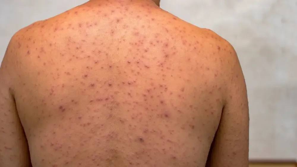 Acre registra 1º caso de Mpox no interior e rastreamento é iniciado; entenda