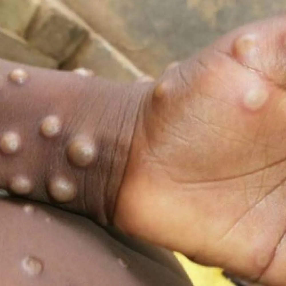 Autoridades de saúde descartam casos de Mpox e monitoram situação epidemiológica em Plácido de Castro