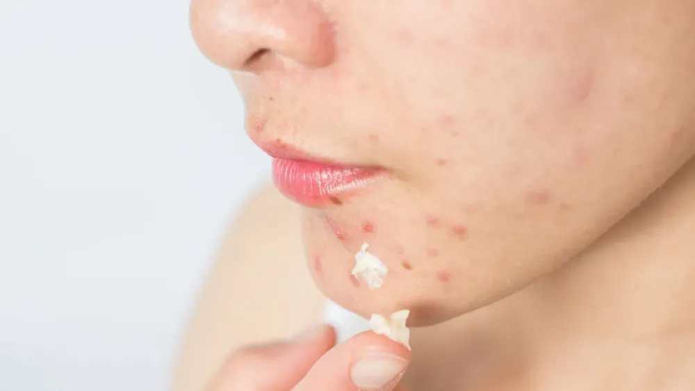 Acnes na adolescência: por que elas surgem e como lidar com elas