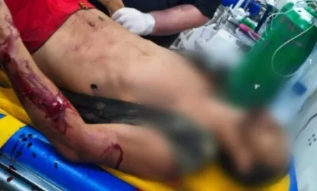 Onofre Lopes Ferreira Júnior, após sofrer ferimentos provocados por um disparo acidental de espingarda; vítima denuncia suposta negativa de socorro por parte do SAMU - Foto: Reprodução Folha do Acre. 