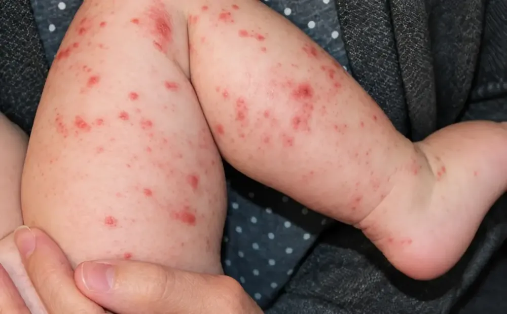 Profissionais de saúde acompanham medidas de vigilância epidemiológica após a confirmação de casos de sarampo em pacientes atendidos no Acre. Foto: Reprodução.
