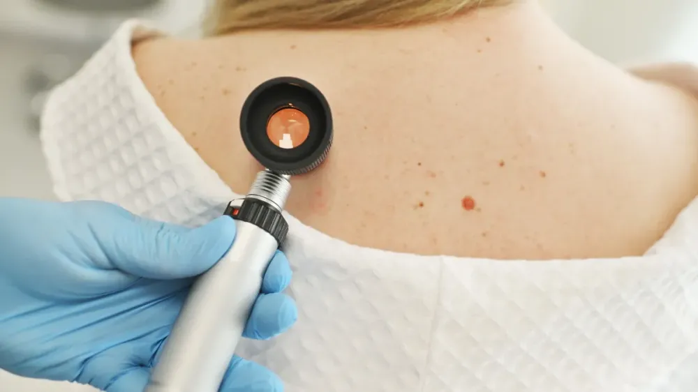 83% dos melanomas no mundo são causados por raios ultravioleta, diz OMS