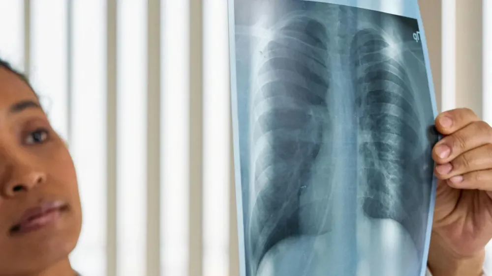 Câncer de pulmão: novo tratamento aumenta tempo de vida de pacientes